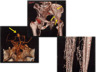 (写真：左から)脳動脈瘤、ASO、足静脈瘤